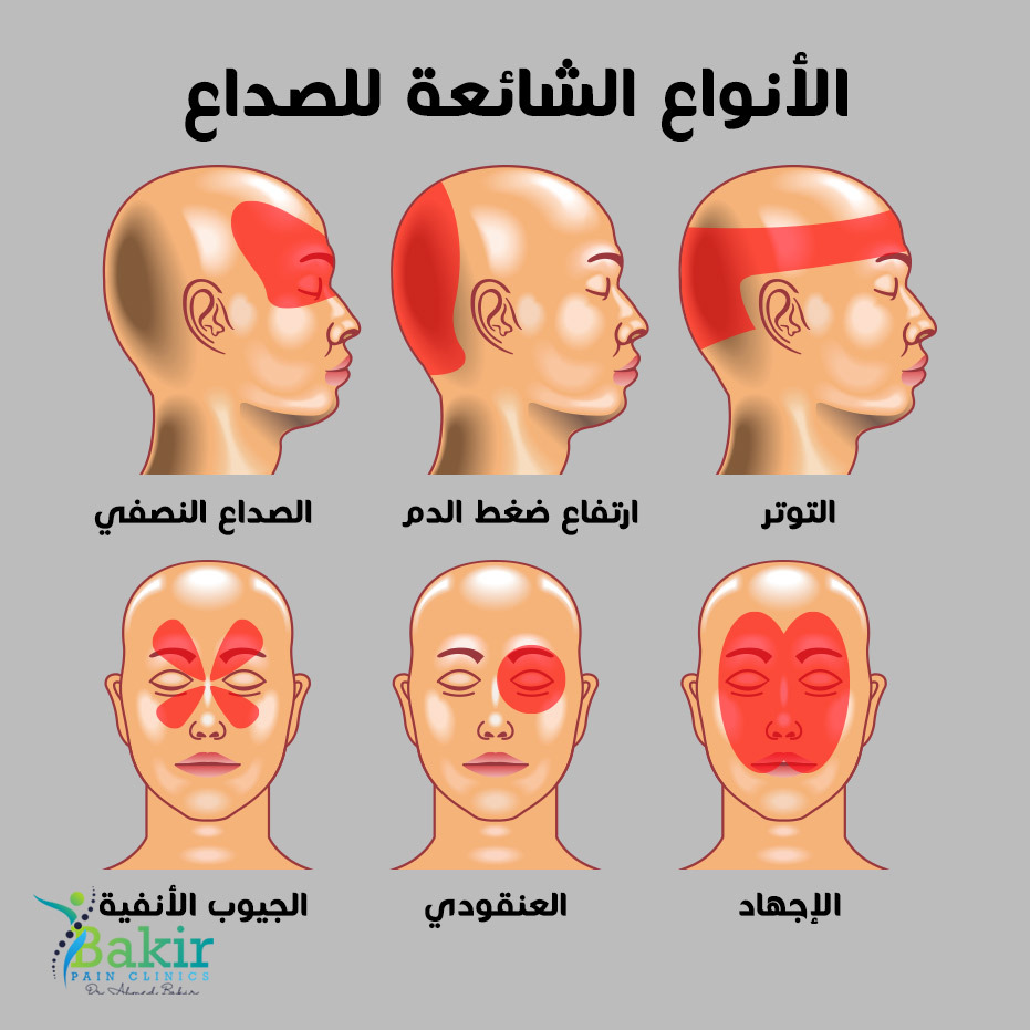 انواع الصداع بالصور